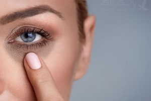 حلقه تیره دور چشم و درمان آن