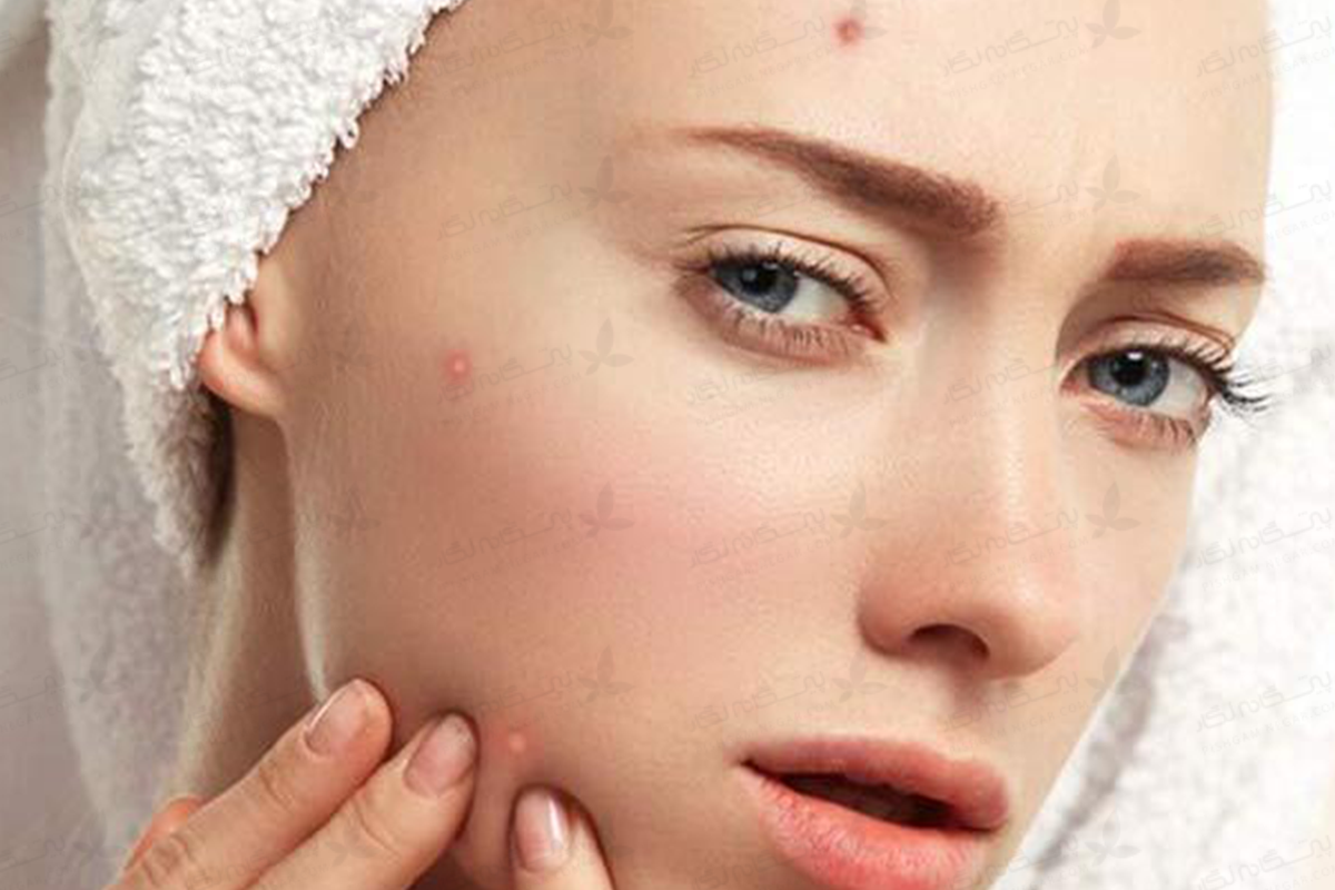 استرس چه تاثیری بر پوست و مو دارد؟